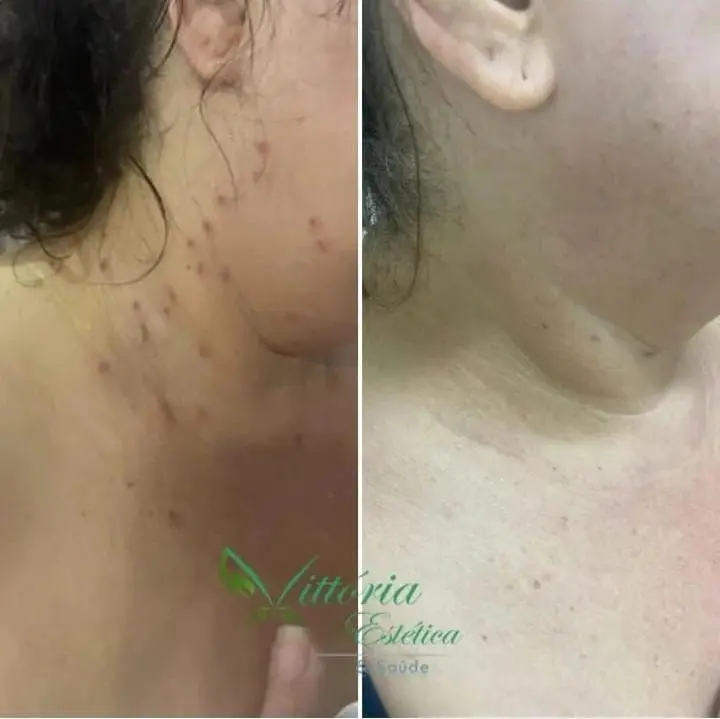 Antes e depois de tratamento de pele