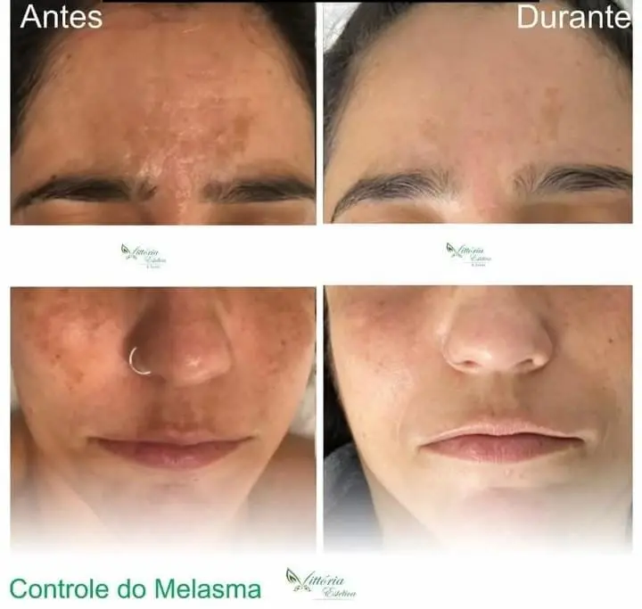 Antes e durante o controle do melasma
