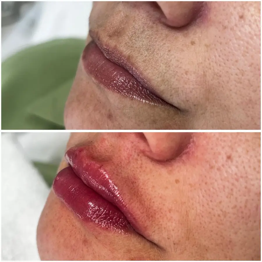 Antes e depois de preenchimento labial