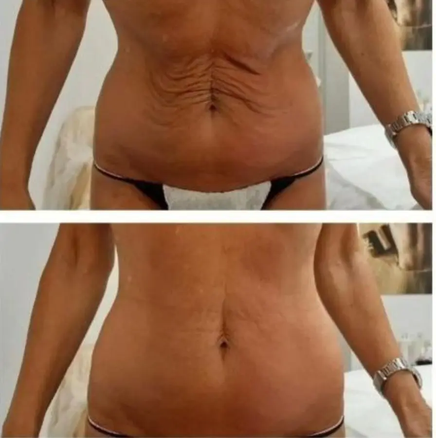 Antes e depois de tratamento abdominal