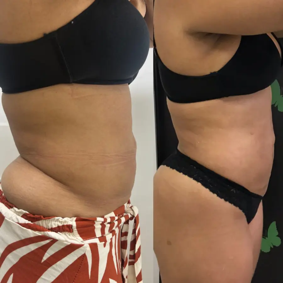 Antes e depois de tratamento corporal